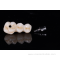 Zirconia Implant bridge